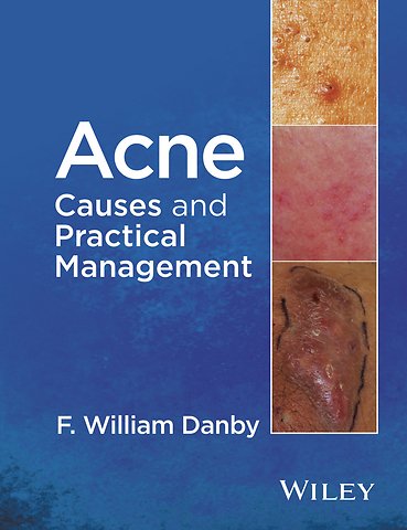 Acne – Causes and Practical Management