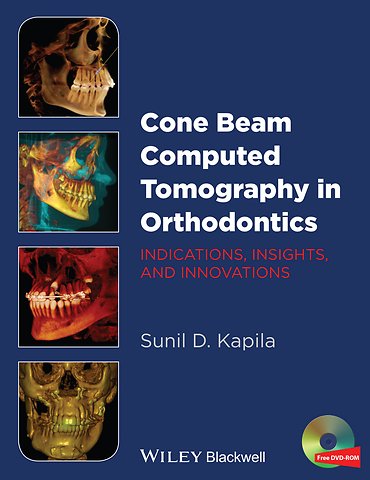 Cone Beam Computed Tomography in Orthodontics – Indications, Insights, and Innovations