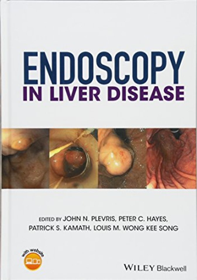 Endoscopy in Liver Disease