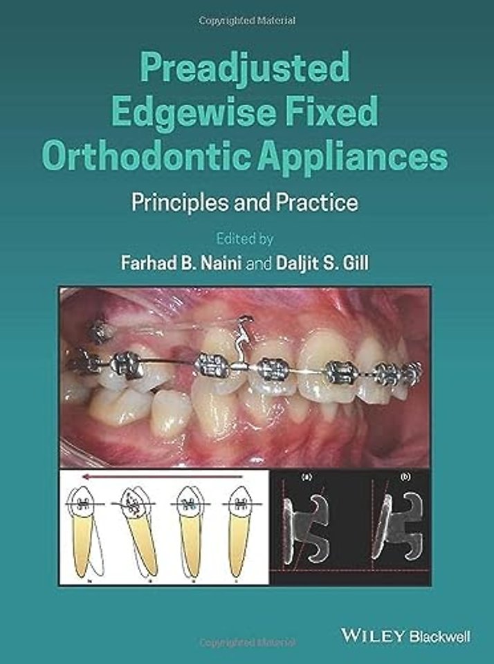 Preadjusted Edgewise Fixed Orthodontic Appliances