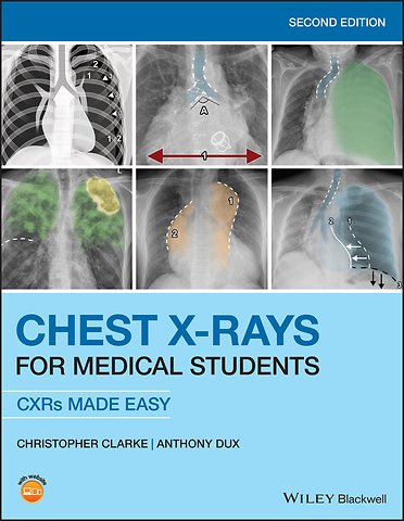Chest X–rays for Medical Students – CXRs Made Easy 2nd Edition