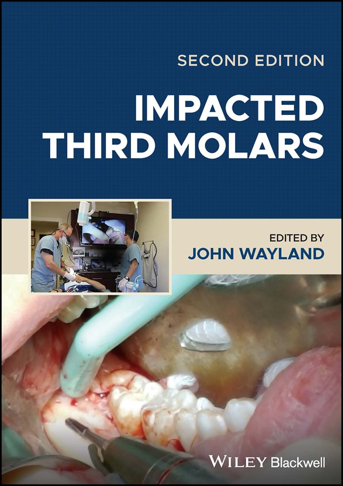 Impacted Third Molars