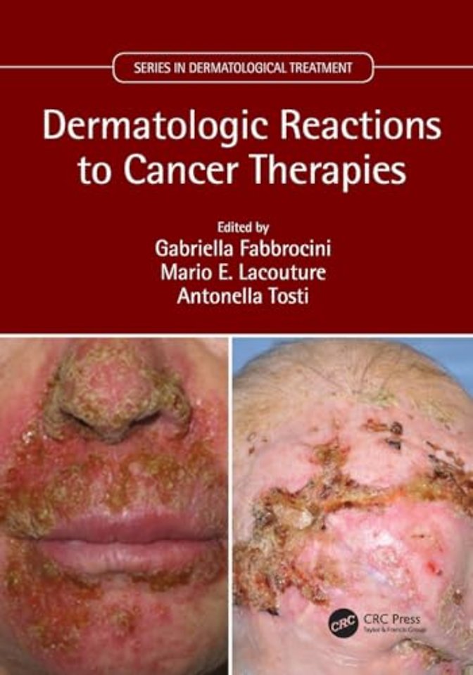Dermatologic Reactions to Cancer Therapies