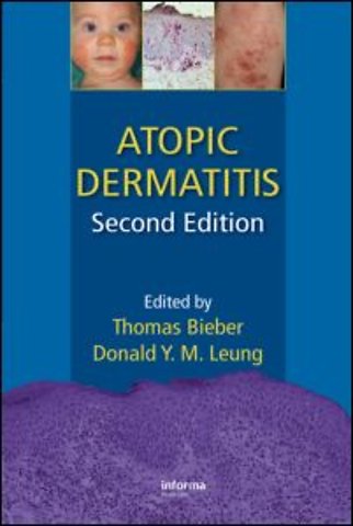 Atopic Dermatitis