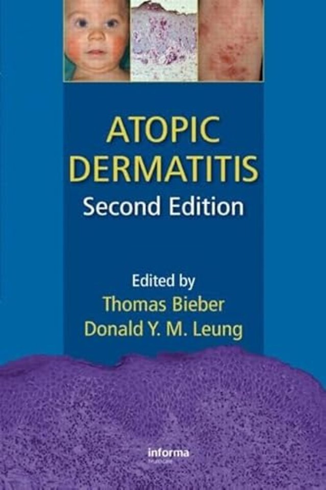 Atopic Dermatitis