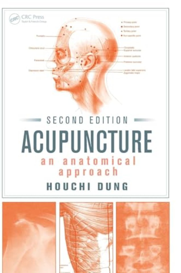 Acupuncture