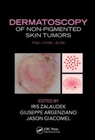 Dermatoscopy of Non-Pigmented Skin Tumors