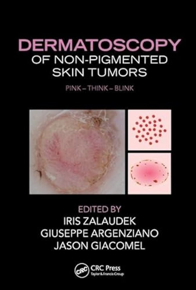 Dermatoscopy of Non-Pigmented Skin Tumors