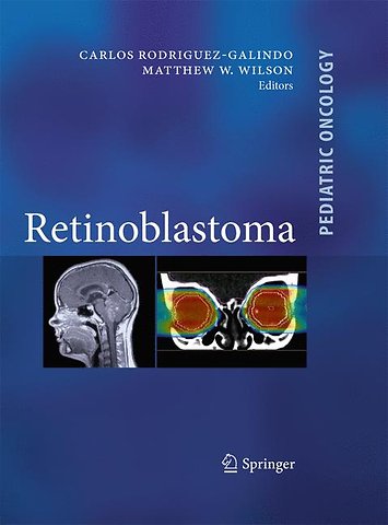 Retinoblastoma
