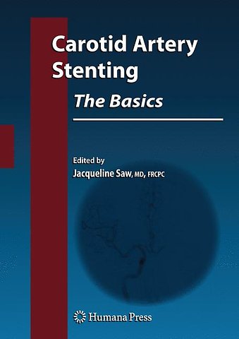 Carotid Artery Stenting: The Basics