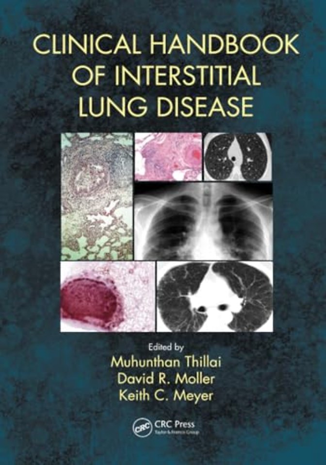 Clinical Handbook of Interstitial Lung Disease