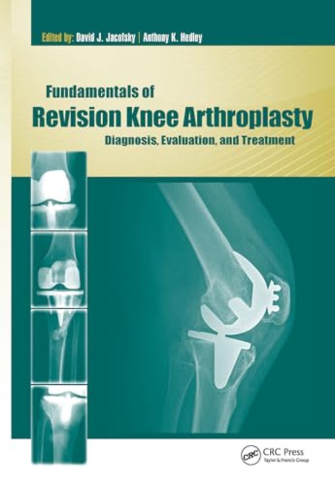 Fundamentals of Revision Knee Arthroplasty