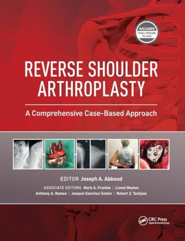 Reverse Shoulder Arthroplasty