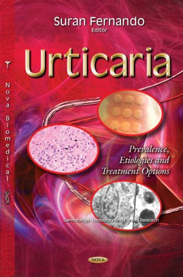 Urticaria