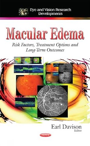 Macular Edema