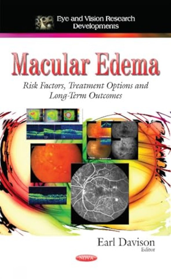 Macular Edema