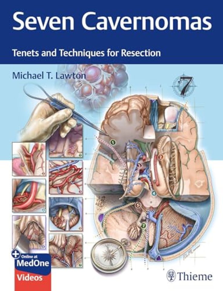 Seven Cavernomas – Tenets and Techniques for Resection