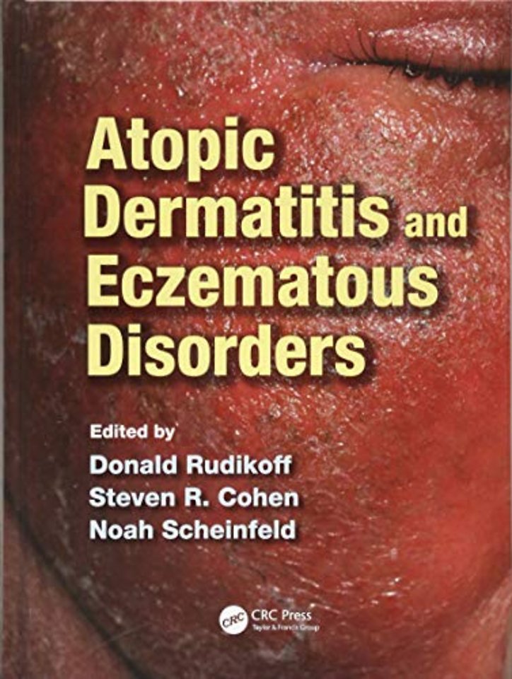 Atopic Dermatitis and Eczematous Disorders