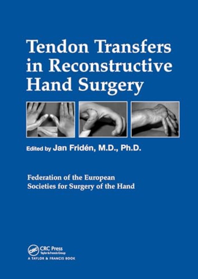 Tendon Transfers in Reconstructive Hand Surgery