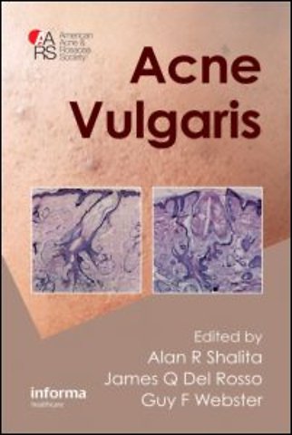 Acne Vulgaris