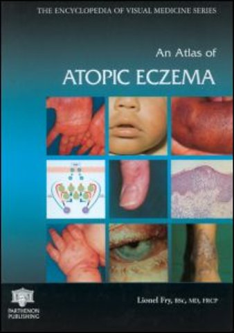 Atlas of Atopic Eczema