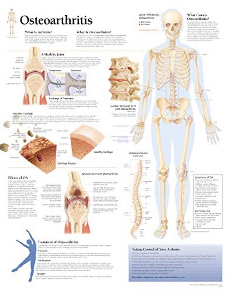 Osteoarthritis Laminated Poster