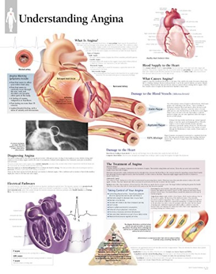 Understanding Angina Paper Poster