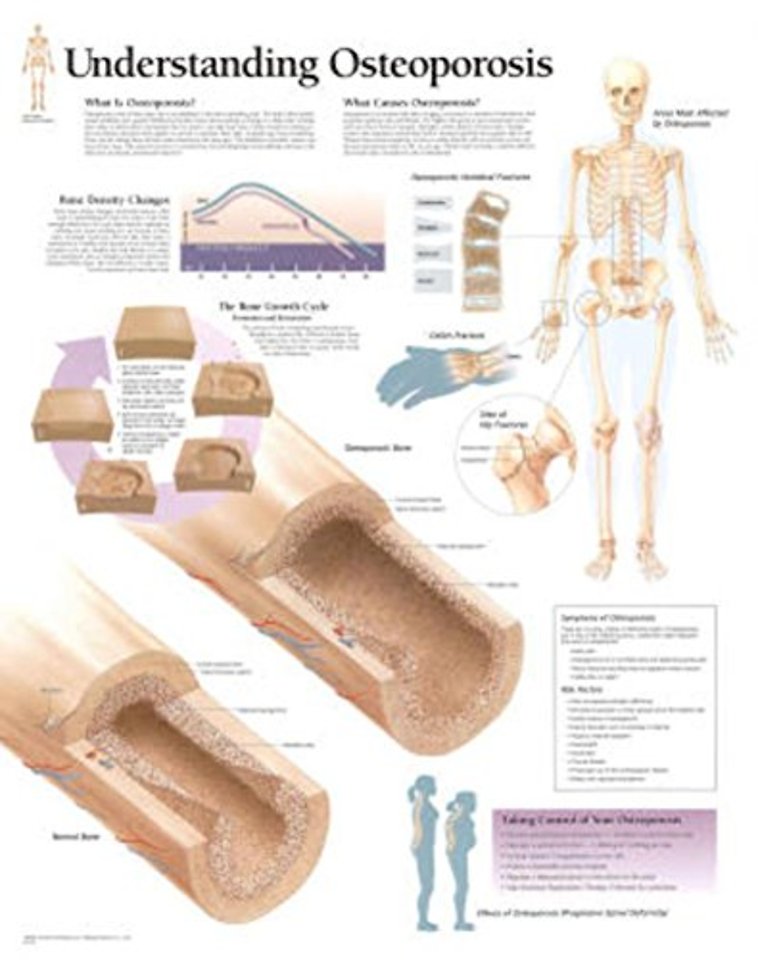 Understanding Osteoporosis Laminated Poster