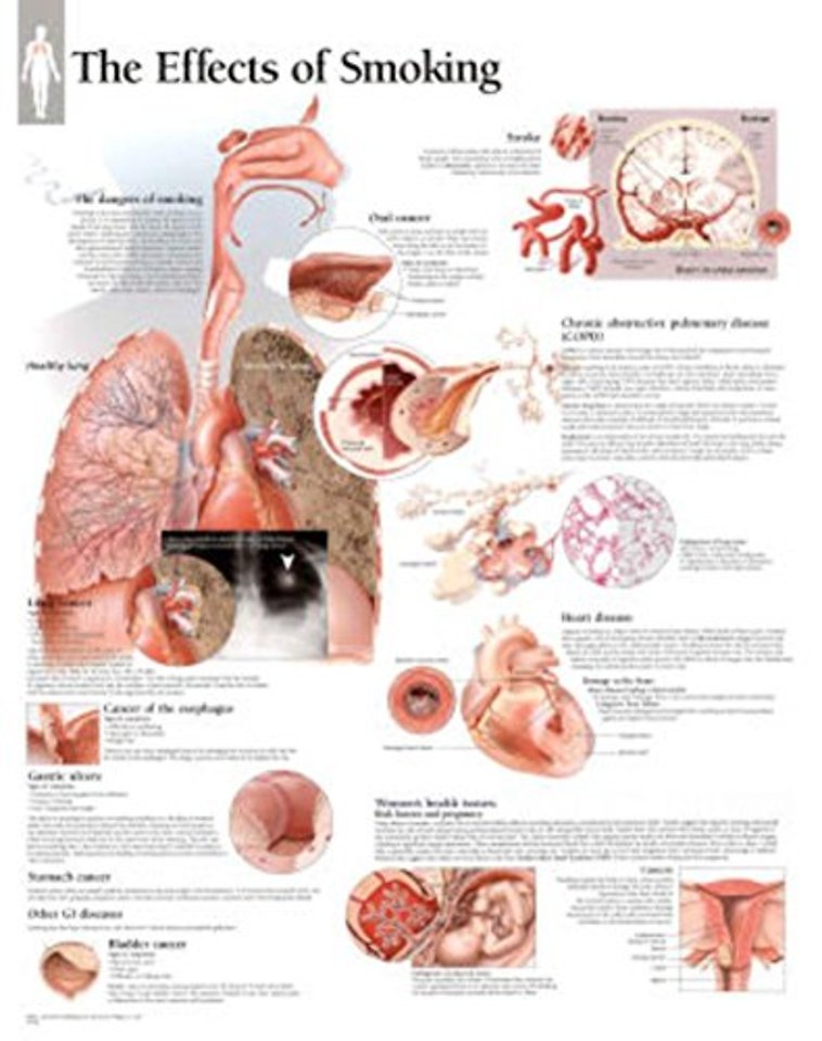 Effects of Smoking Laminated Poster
