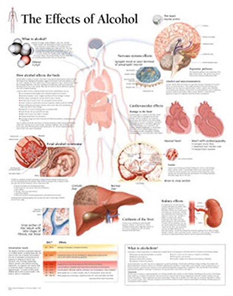 Effects of Alcohol Laminated Poster