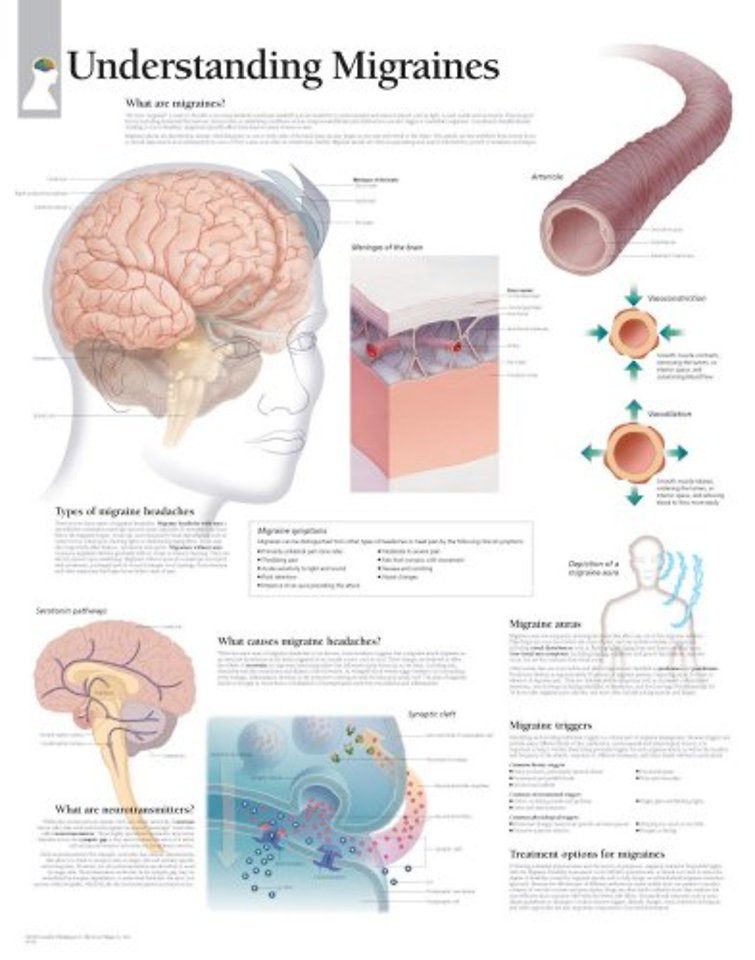 Understanding Migraines Laminated Poster
