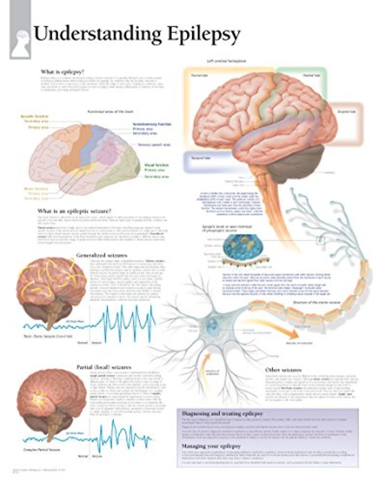 Understanding Epilepsy Laminated Poster
