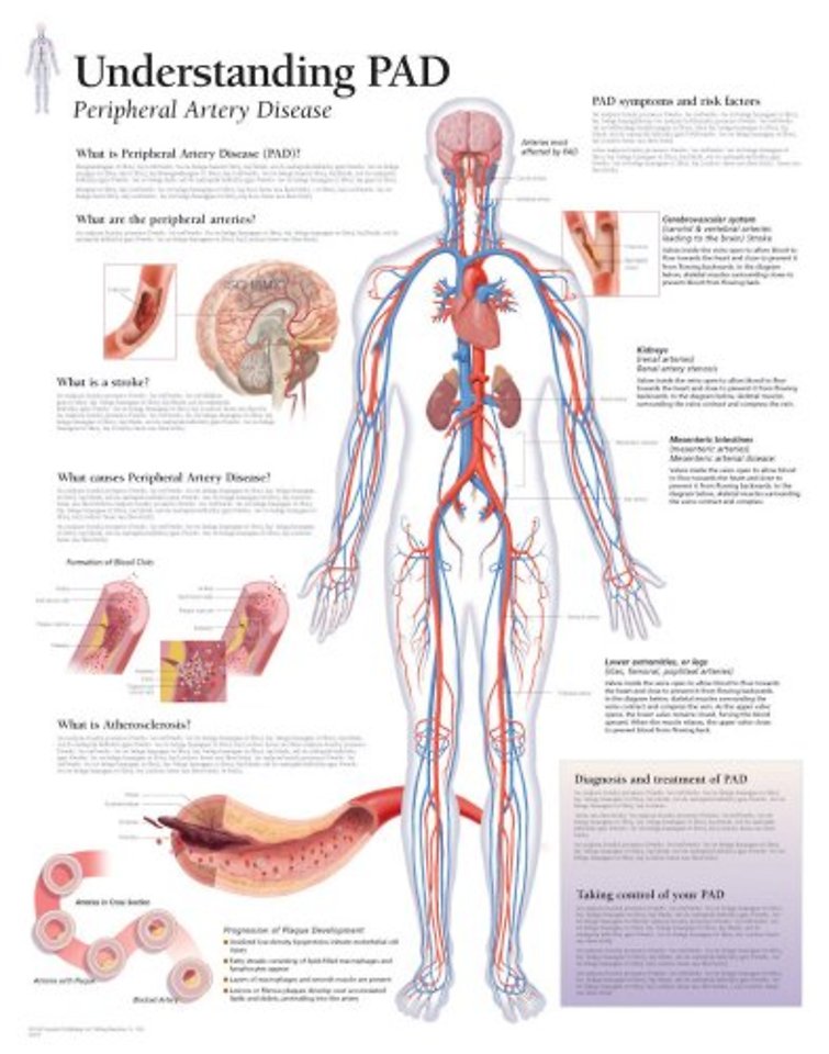 Understanding PAD Laminated Poster