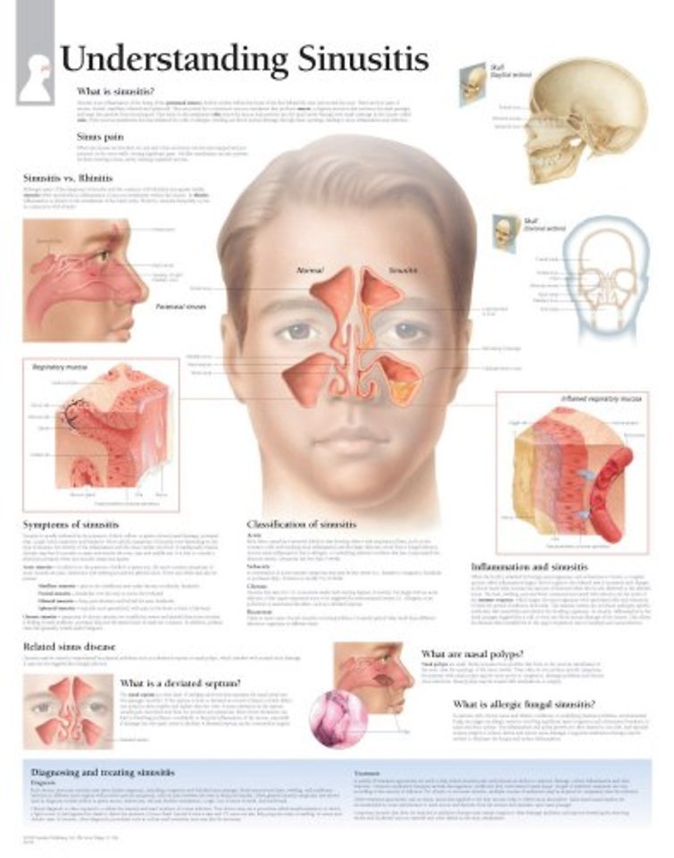 Understanding Sinusitis Laminated Poster