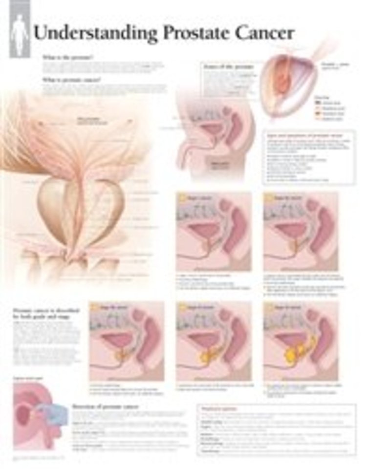 Understanding Prostate Cancer Paper Poster
