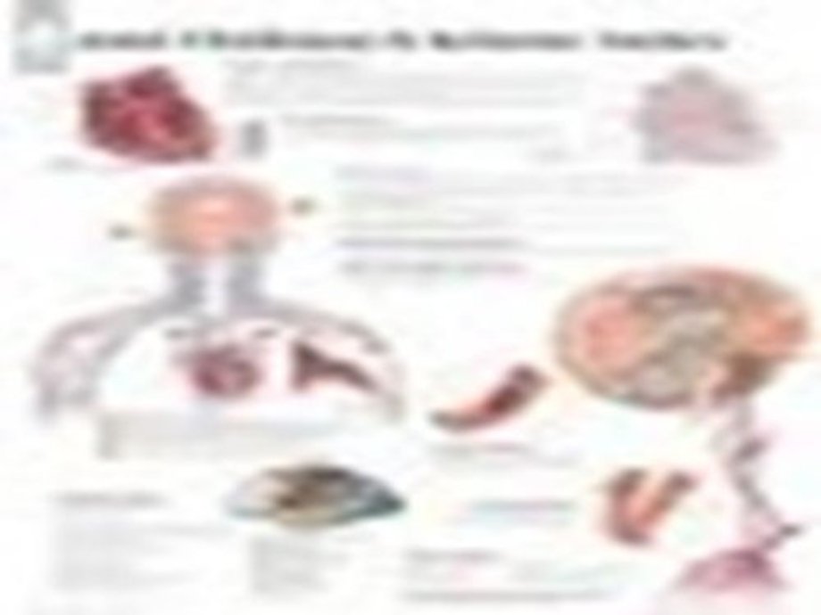 Atrial Fib & Ischemic Strokes Laminated Poster
