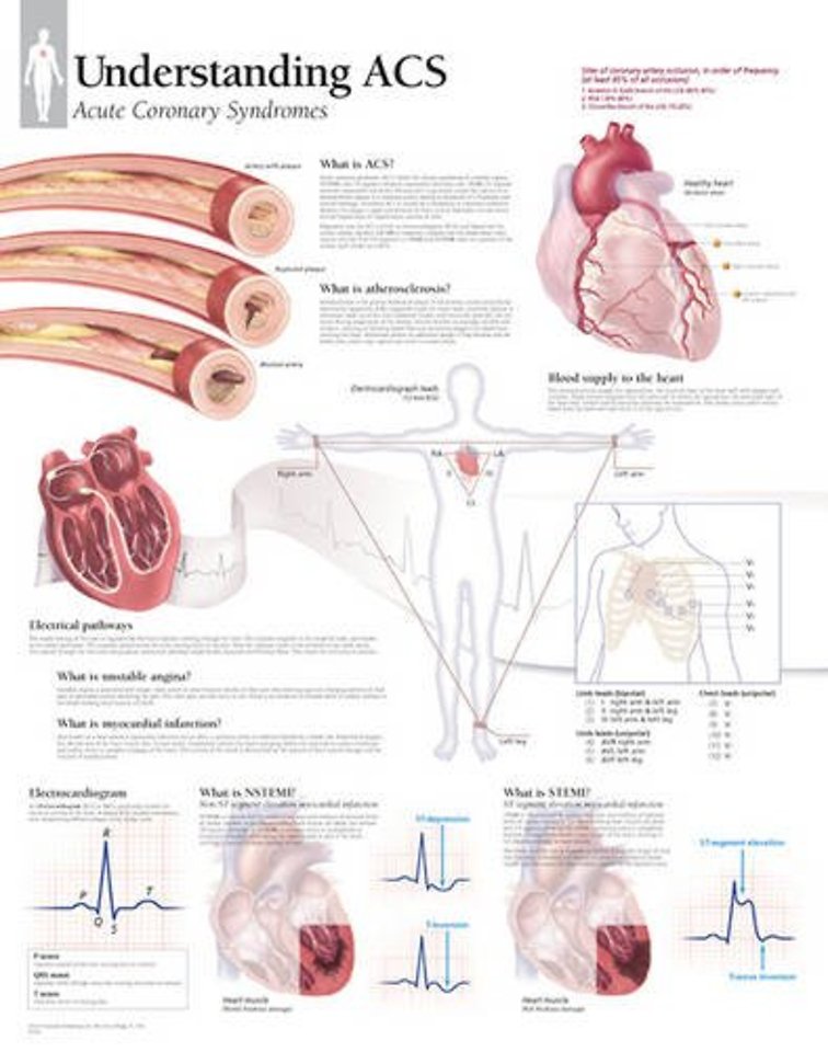 Understanding ACS (Acute Coronary Syndrome) Paper Poster