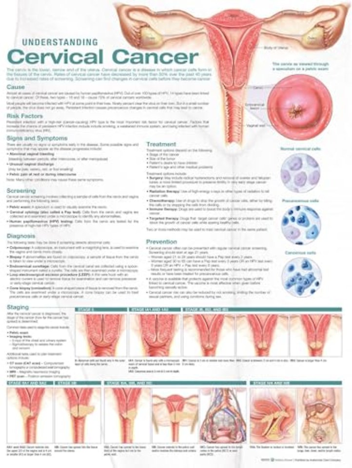 Understanding Cervical Cancer Anatomical Chart