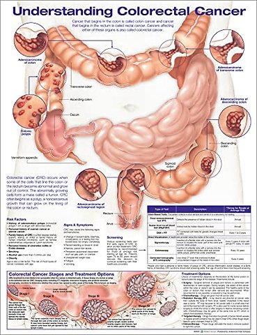 Understanding Colorectal Cancer Anatomical Chart