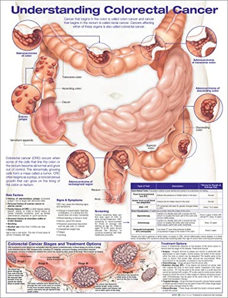 Understanding Colorectal Cancer Anatomical Chart