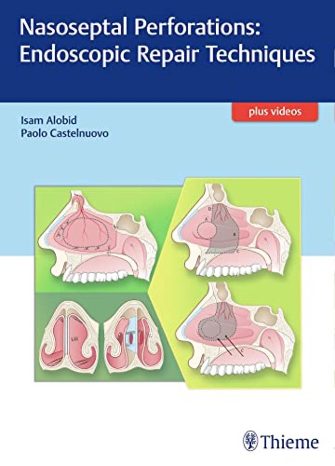 Nasoseptal Perforations
