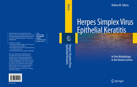 Herpes Simplex Virus Epithelial Keratitis