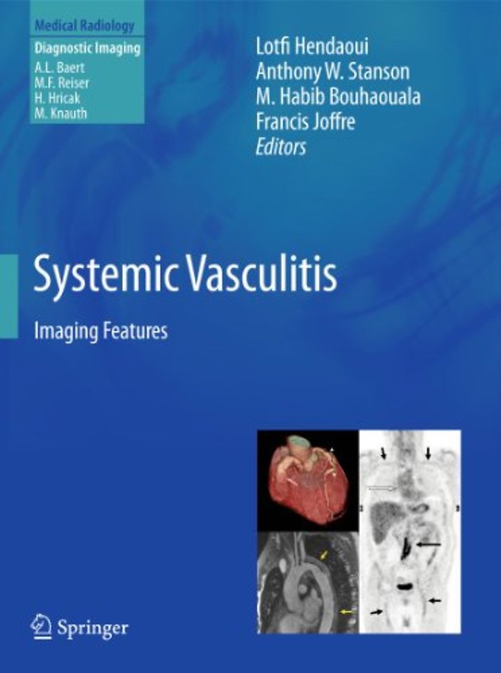 Systemic Vasculitis