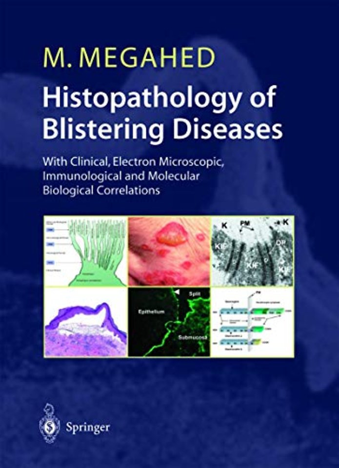 Histopathology of Blistering Diseases