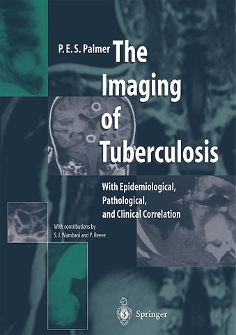 The Imaging of Tuberculosis