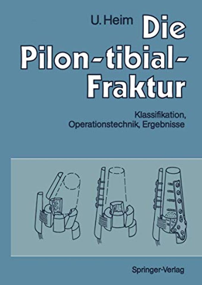 Die Pilon-tibial-Fraktur