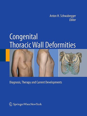 Congenital Thoracic Wall Deformities