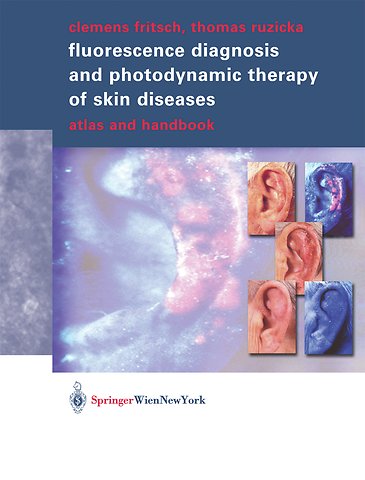 Fluorescence Diagnosis and Photodynamic Therapy of Skin Diseases