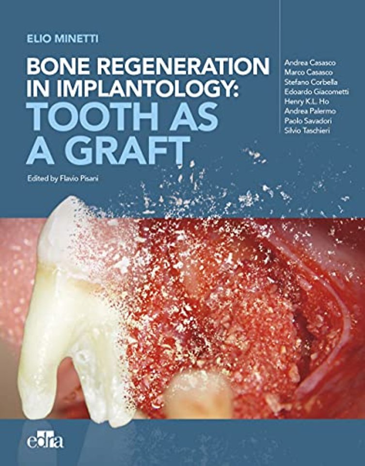 Bone regeneration in implantology - tooth as a graft