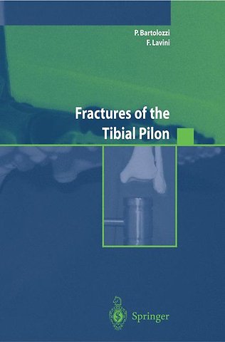 Fractures of the Tibial Pilon